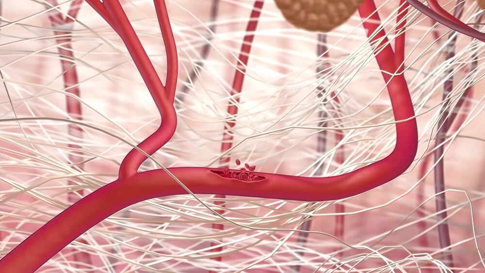 Internal Rupture Sacramento Attorneys for Internal Bleeding from Car Accident